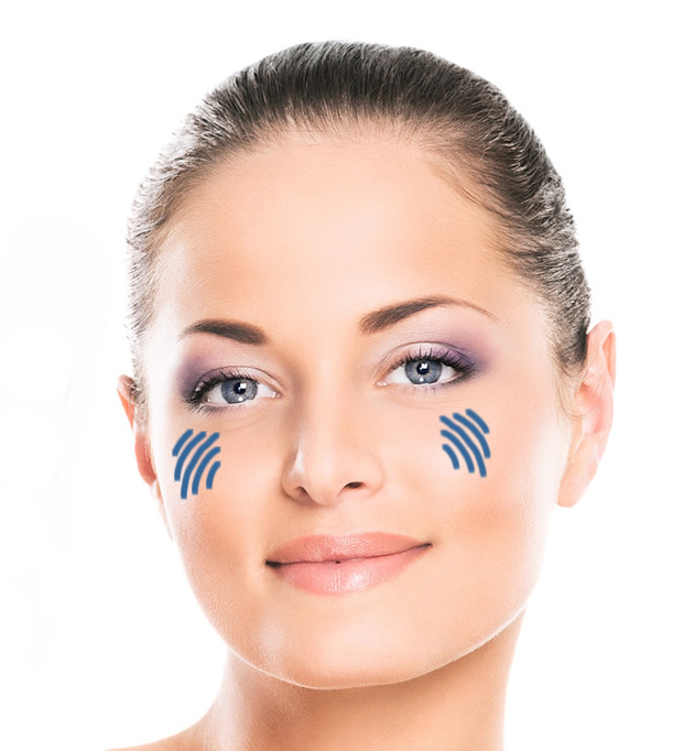 Injection d'acide hyaluronique - pommettes